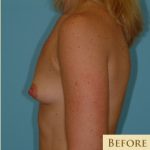 Breast Augmentation Before & After Patient #2882