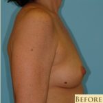 Breast Augmentation Before & After Patient #2883