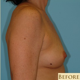 Breast Augmentation Before & After Patient #2883