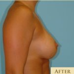 Breast Augmentation Before & After Patient #2878