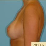 Breast Augmentation Before & After Patient #2880