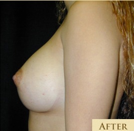 Breast Augmentation Before & After Patient #2881