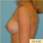 Breast Augmentation Before & After Patient #2882