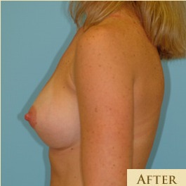 Breast Augmentation Before & After Patient #2882