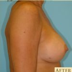 Breast Augmentation Before & After Patient #2883