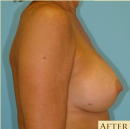 Breast Augmentation Before & After Patient #2883