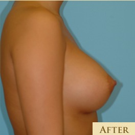 Breast Augmentation Before & After Patient #2875