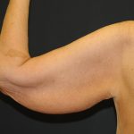 Arm Lift Before & After Patient #2981