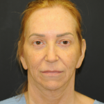 Facelift Before & After Patient #2980