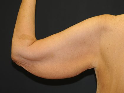 Arm Lift Before & After Patient #2981