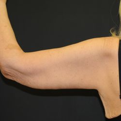 Arm Lift Before & After Patient #2981