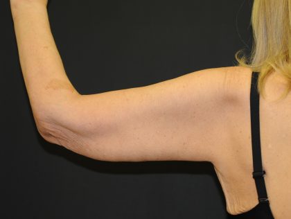 Arm Lift Before & After Patient #2981