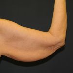 Arm Lift Before & After Patient #2981