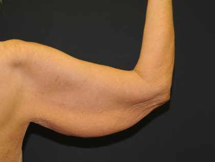 Arm Lift Before & After Patient #2981