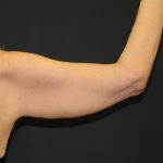Arm Lift Before & After Patient #2981