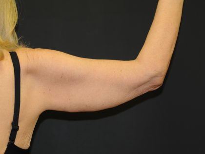 Arm Lift Before & After Patient #2981