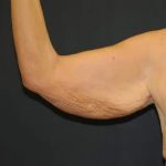 Arm Lift Before & After Patient #2981