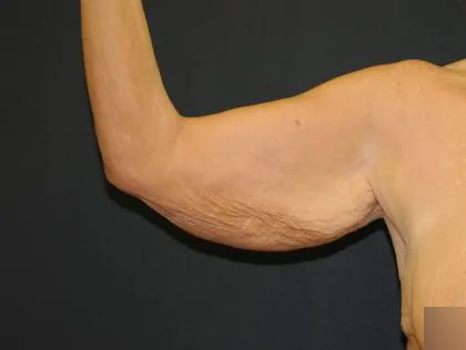 Arm Lift Before & After Patient #2981