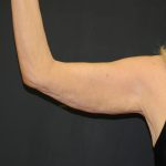 Arm Lift Before & After Patient #2981