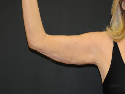 Arm Lift Before & After Patient #2981
