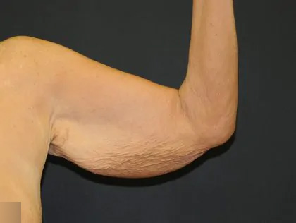 Arm Lift Before & After Patient #2981