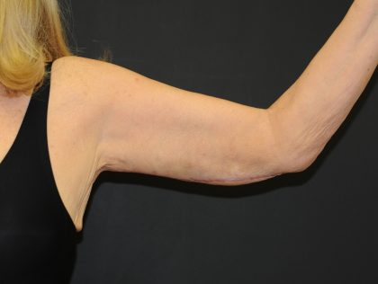 Arm Lift Before & After Patient #2981