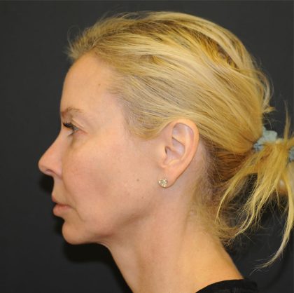 Brow Lift Before & After Patient #2982