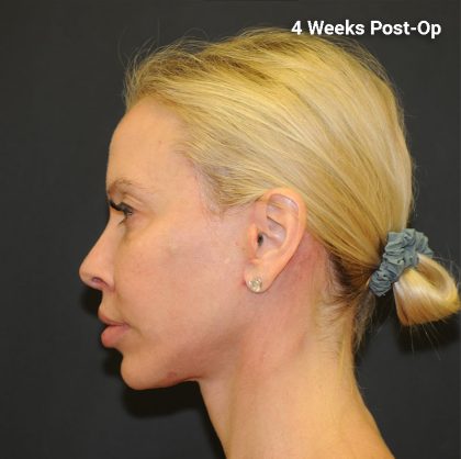 Brow Lift Before & After Patient #2982