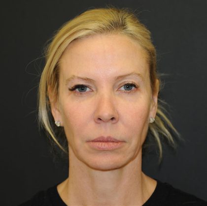 Brow Lift Before & After Patient #2982