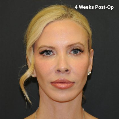Brow Lift Before & After Patient #2982
