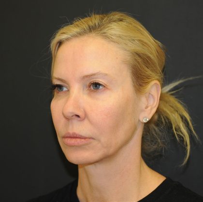 Brow Lift Before & After Patient #2982