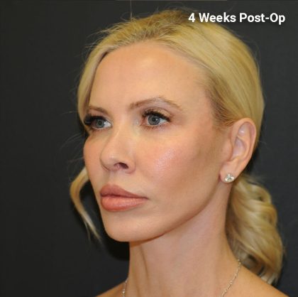 Brow Lift Before & After Patient #2982