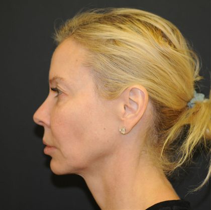 Brow Lift Before & After Patient #2982