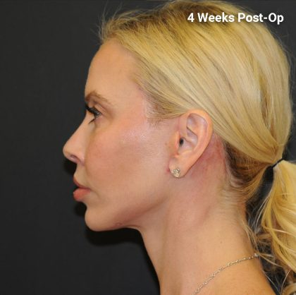 Brow Lift Before & After Patient #2982