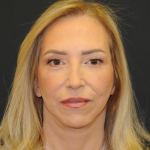 Facelift Before & After Patient #2980