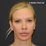 Lip Lift Before & After Patient #3026