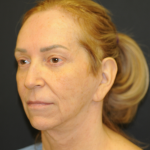 Facelift Before & After Patient #2980