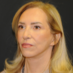 Facelift Before & After Patient #2980