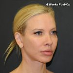 Lip Lift Before & After Patient #3026