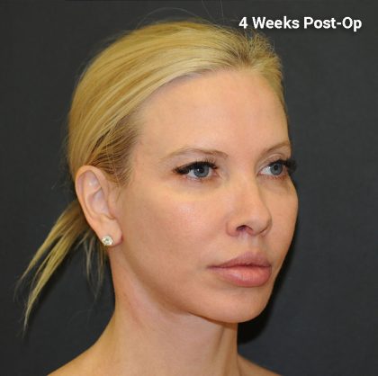 Brow Lift Before & After Patient #2982