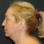 Facelift Before & After Patient #2980