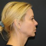 Lip Lift Before & After Patient #3026
