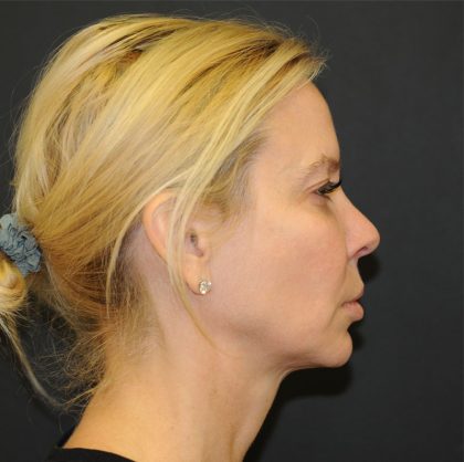 Brow Lift Before & After Patient #2982