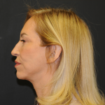 Facelift Before & After Patient #2980