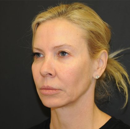 Brow Lift Before & After Patient #2982