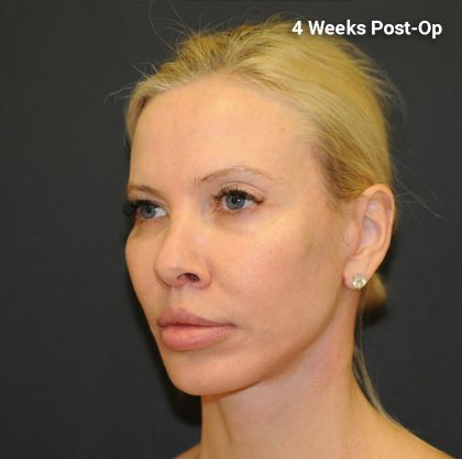Facelift Before & After Patient #3025
