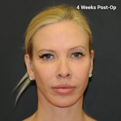 Facelift Before & After Patient #3025