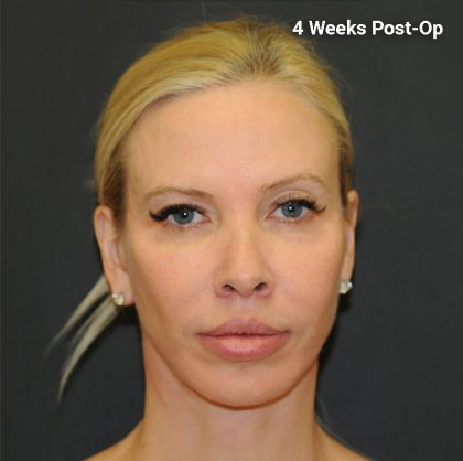 Facelift Before & After Patient #3025
