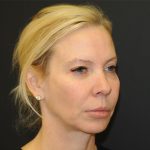 Facelift Before & After Patient #3025