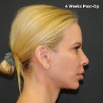 Facelift Before & After Patient #3025
